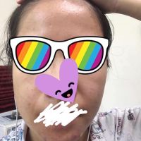 Làm sao để trị mụn và trị thâm
