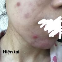 Làm sao để trị mụn và trị thâm