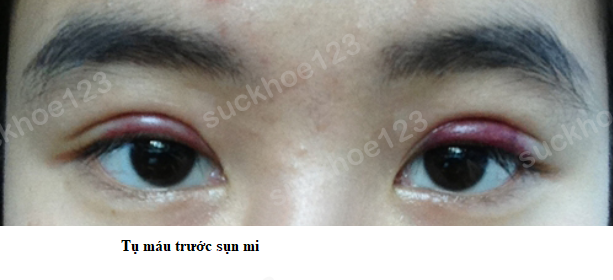 tụ máu trước sụn mi