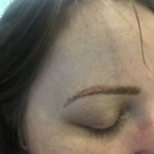 Điêu khắc chân mày được 6 ngày mà đã bong mất một nửa?