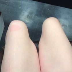 Đùi bị phồng lên sau căng da đùi có bình thường không?