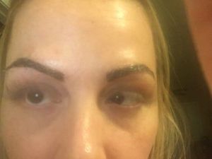 Chân mày không tự nhiên sau khi điêu khắc