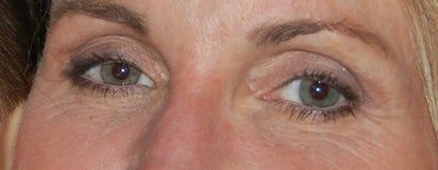 Da dưới mắt nhăn nheo sau khi tiêm tan filler Da dưới mắt nhăn nheo sau khi tiêm tan filler