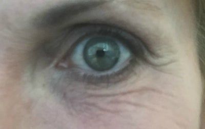 Da dưới mắt nhăn nheo sau khi tiêm tan filler Da dưới mắt nhăn nheo sau khi tiêm tan filler