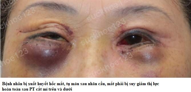 xuất huyết hốc mắt 2