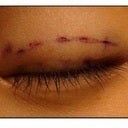 Sau khi bấm mí: có thể tiếp tục bấm mí lại nhiều lần nữa không?