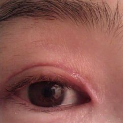 Có nên chỉnh sửa sẹo xấu sau mở góc mắt trong?