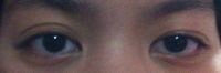 Một bên mí mắt có nhiều nếp mí, một bên thì không
