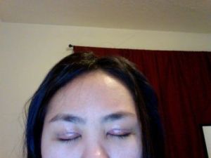 4 ngày sau cắt mí: mí mắt của tôi có giảm sưng được nhiều nữa không?