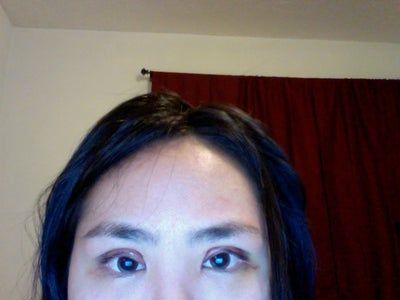 4 ngày sau cắt mí: mí mắt của tôi có giảm sưng được nhiều nữa không?