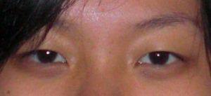 2 tháng sau phẫu thuật cắt mí: mí mắt không đều