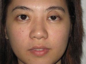 Mí mắt trên trũng sâu sau khi phẫu thuật chỉnh sửa sụp mí.