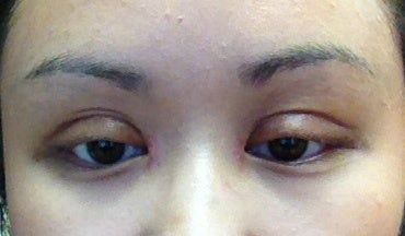 Nếp gấp mí khi nhắm mắt cao 7mm có được không? Nếp gấp mí khi nhắm mắt cao 7mm có được không?