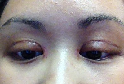 Nếp gấp mí khi nhắm mắt cao 7mm có được không? Nếp gấp mí khi nhắm mắt cao 7mm có được không?