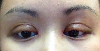 Nếp gấp mí khi nhắm mắt cao 7mm có được không? Nếp gấp mí khi nhắm mắt cao 7mm có được không?