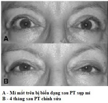 Biến dạng mí mắt sau PT sụp mí1