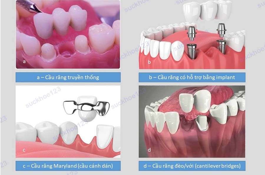 Các loại cầu răng