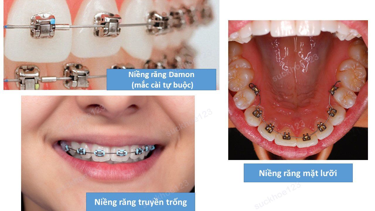 các loại niềng răng1