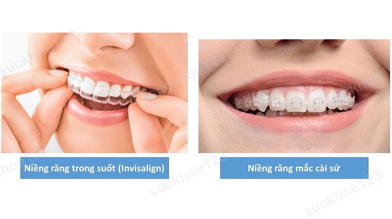 các loại niềng răng2
