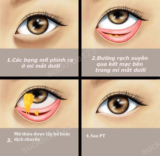 cắt mí dưới kết mạc