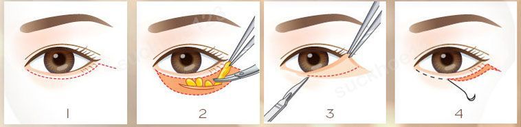 cắt mí dưới ngoài da