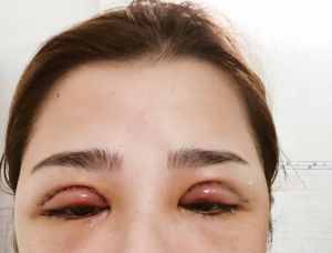 Mới cắt mí xong bị sưng quá