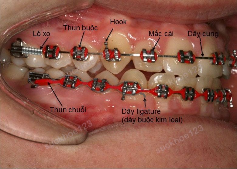 component niềng răng