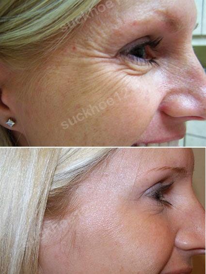 hinh anh tiem botox dr tam ca 2 1vet chan chim