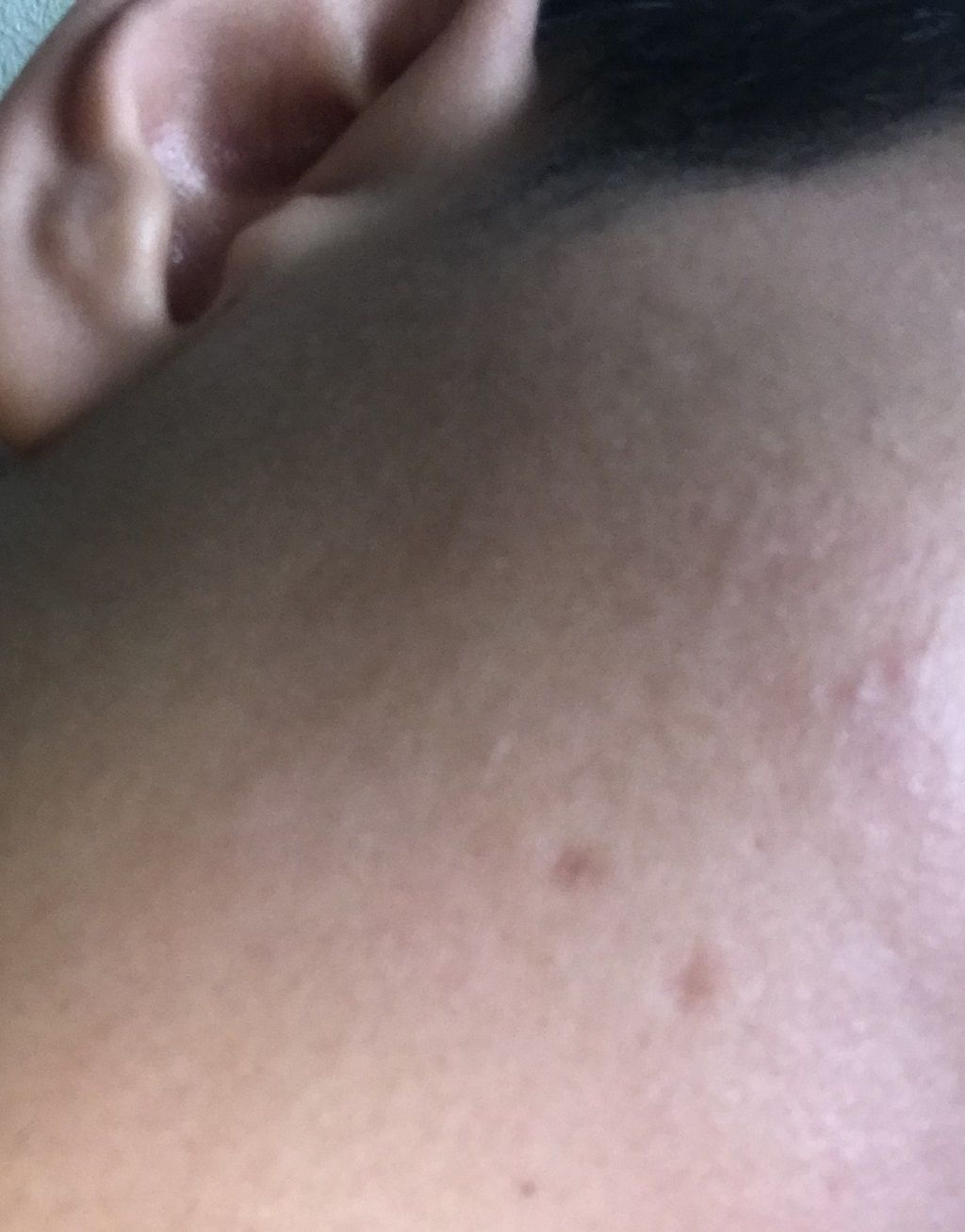 Tẩy nốt ruồi bị mọc lại Tẩy nốt ruồi bị mọc lại