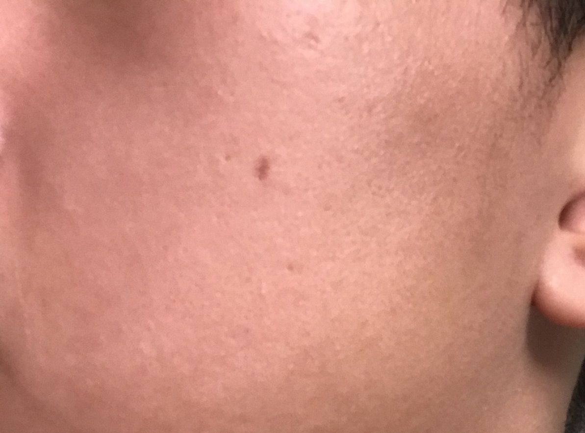 Tẩy nốt ruồi bị mọc lại Tẩy nốt ruồi bị mọc lại