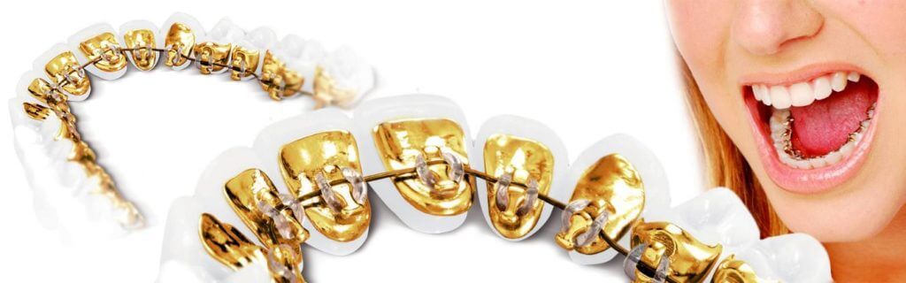 incognito niềng răng