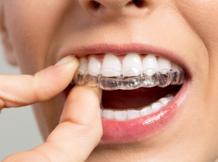 invisalign 2