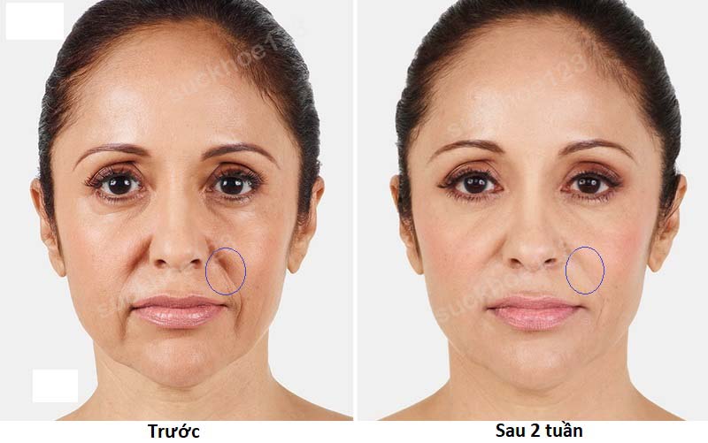 juvederm01