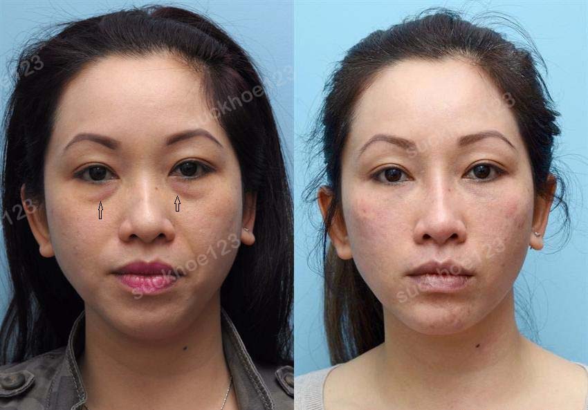 juvederm02