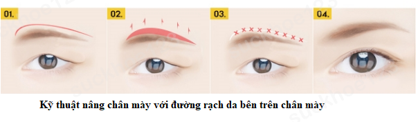 KT nâng chân mày1