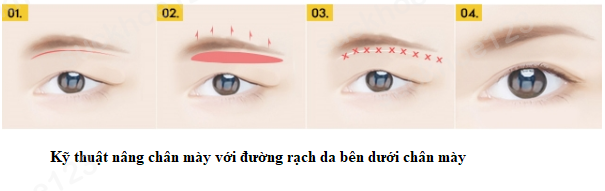 KT nâng chân mày2