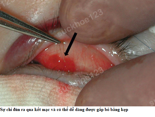 lộ nút thắt chỉ 3