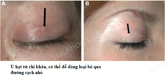 lộ nút thắt chỉ 5