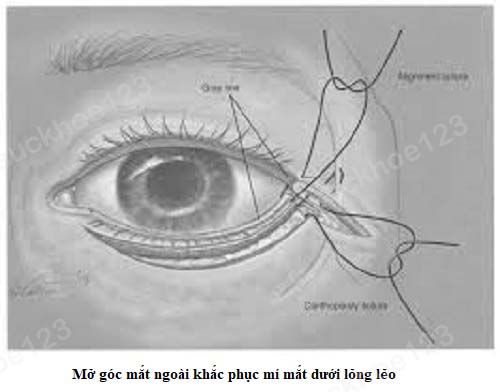 mí dưới lỏng lẻo 4