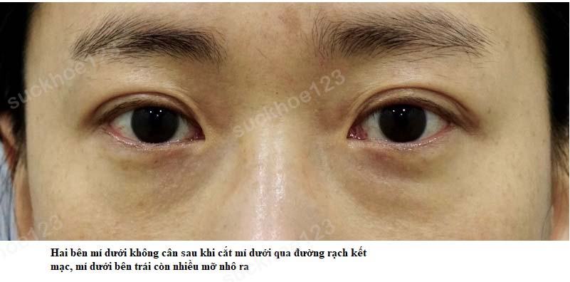 mí mắt ko cân 1