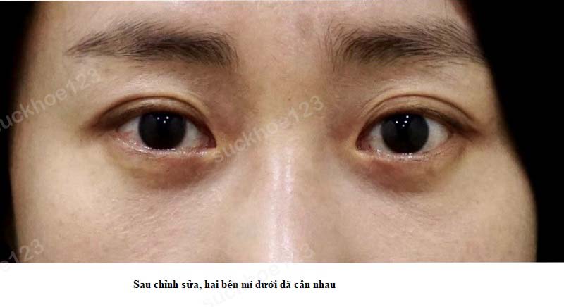 mí mắt ko cân 2