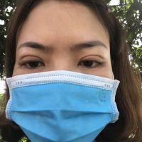 Mắt vẫn bị sưng và trợn sau hơn 2,5 tháng cắt mí