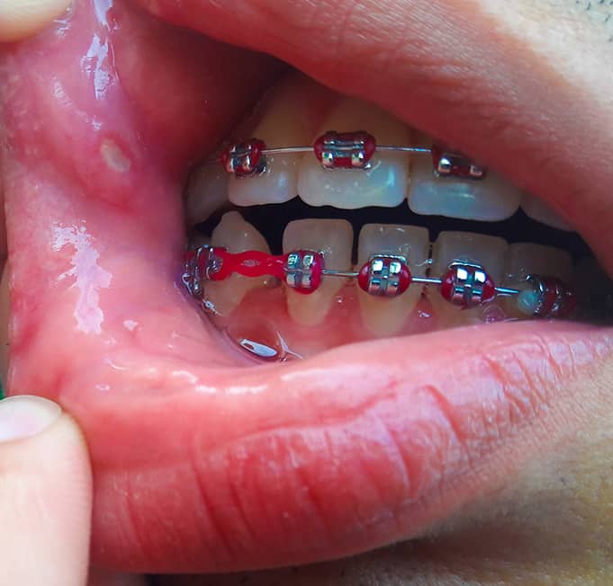môi má bị kích ứng