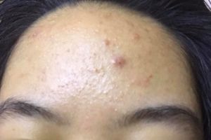 ĐÂY LÀ MỤN GÌ?