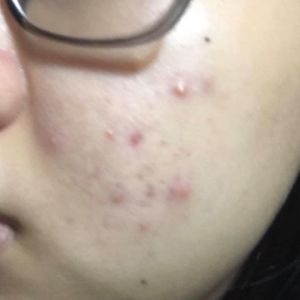 ĐÂY LÀ MỤN GÌ?