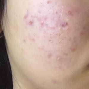 ĐÂY LÀ MỤN GÌ?