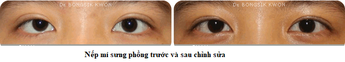 nếp mí sưng phồng 1