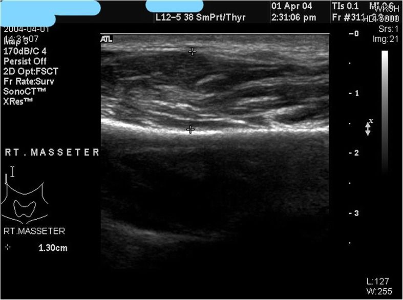 nghien cuu tiem botox1