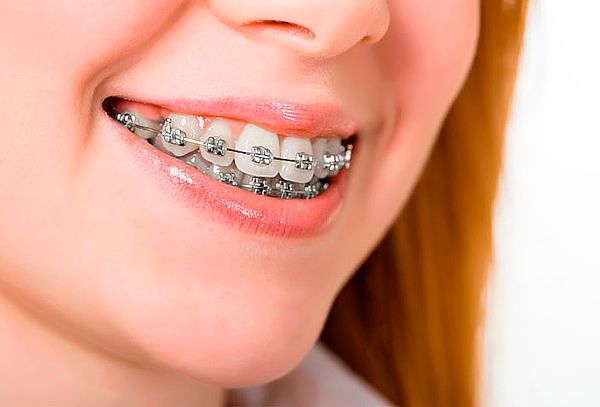 răng cắn vào mắc cài