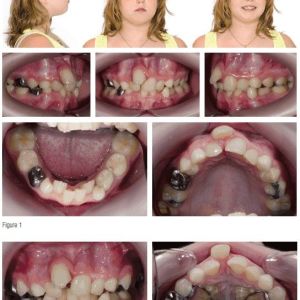 Phân tích case: Răng mọc chen chúc nghiêm trọng cùng với sự bất tương quan xương theo chiều ngang ảnh hưởng đến lòng tự trọng của bệnh nhân